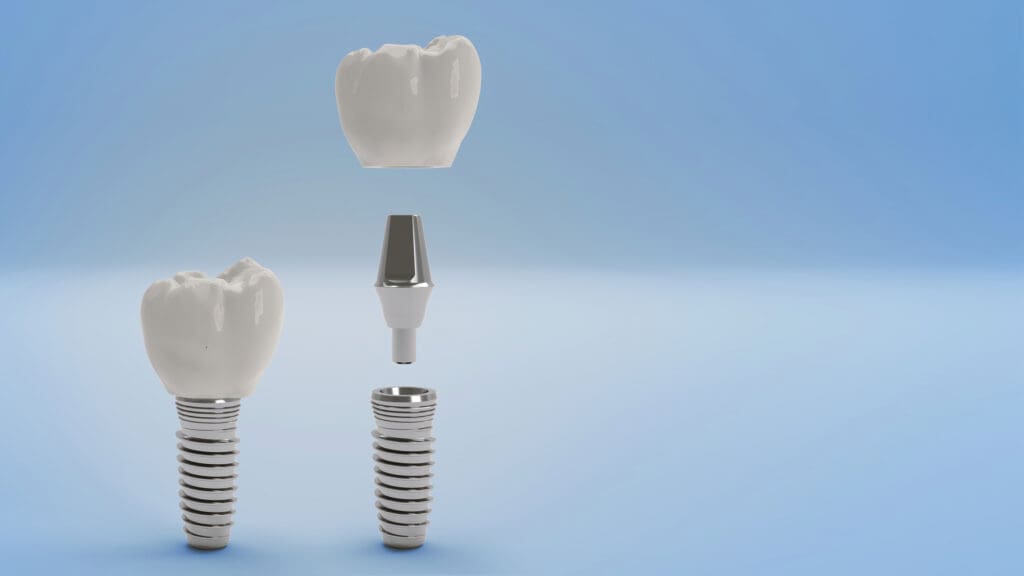 Affordable Dental Implants in Indianapolis IN