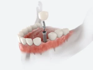 Dental Implants Step by Step: What to Expect in Indianapolis, IN