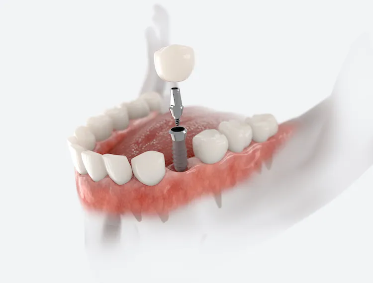 Dental Implants Step by Step: What to Expect in Indianapolis, IN
